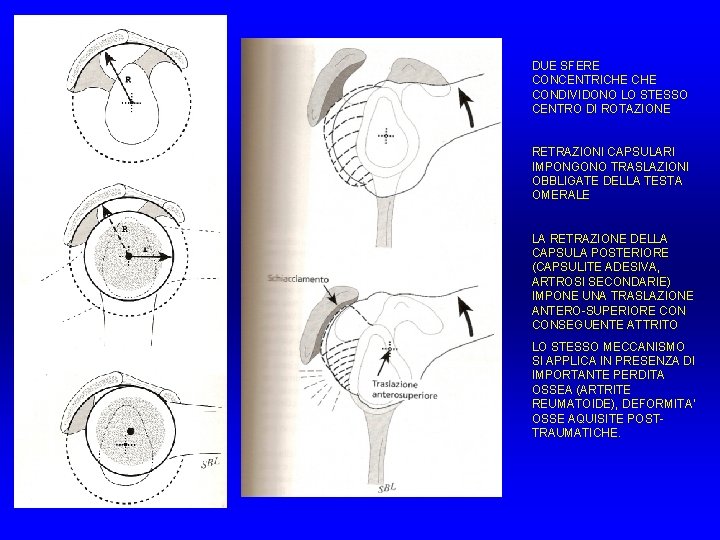DUE SFERE CONCENTRICHE CONDIVIDONO LO STESSO CENTRO DI ROTAZIONE RETRAZIONI CAPSULARI IMPONGONO TRASLAZIONI OBBLIGATE DUE SFERE CONCENTRICHE CONDIVIDONO LO STESSO CENTRO DI ROTAZIONE RETRAZIONI CAPSULARI IMPONGONO TRASLAZIONI OBBLIGATE