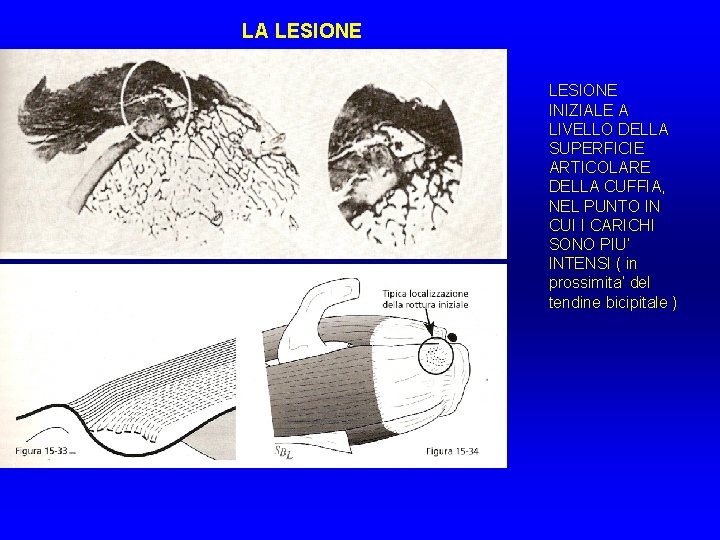 LA LESIONE INIZIALE A LIVELLO DELLA SUPERFICIE ARTICOLARE DELLA CUFFIA, NEL PUNTO IN CUI LA LESIONE INIZIALE A LIVELLO DELLA SUPERFICIE ARTICOLARE DELLA CUFFIA, NEL PUNTO IN CUI