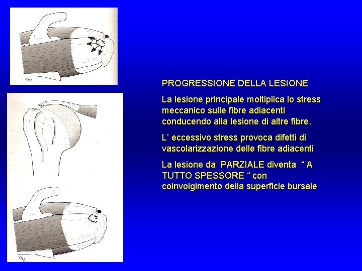 PROGRESSIONE DELLA LESIONE La lesione principale moltiplica lo stress meccanico sulle fibre adiacenti conducendo PROGRESSIONE DELLA LESIONE La lesione principale moltiplica lo stress meccanico sulle fibre adiacenti conducendo