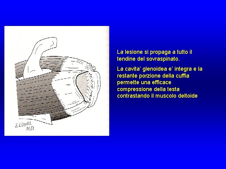 La lesione si propaga a tutto il tendine del sovraspinato. La cavita’ glenoidea e’ La lesione si propaga a tutto il tendine del sovraspinato. La cavita’ glenoidea e’