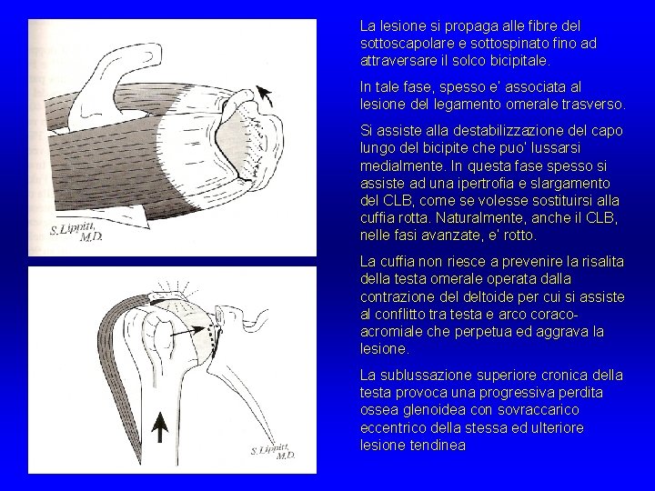 La lesione si propaga alle fibre del sottoscapolare e sottospinato fino ad attraversare il La lesione si propaga alle fibre del sottoscapolare e sottospinato fino ad attraversare il