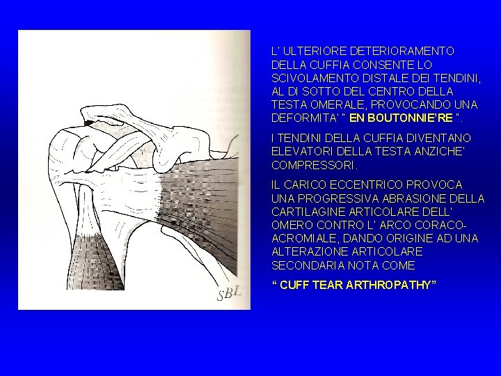 L’ ULTERIORE DETERIORAMENTO DELLA CUFFIA CONSENTE LO SCIVOLAMENTO DISTALE DEI TENDINI, AL DI SOTTO L’ ULTERIORE DETERIORAMENTO DELLA CUFFIA CONSENTE LO SCIVOLAMENTO DISTALE DEI TENDINI, AL DI SOTTO
