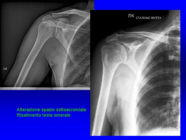 Alterazione spazio sottoacromiale Risalimento testa omerale Alterazione spazio sottoacromiale Risalimento testa omerale
