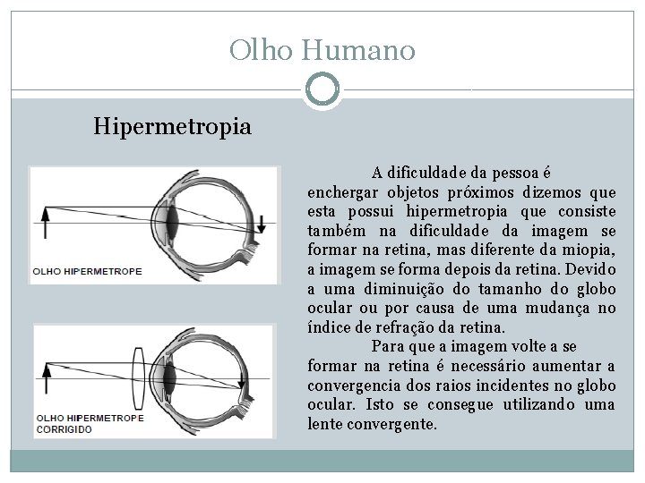 Olho Humano Hipermetropia A dificuldade da pessoa é enchergar objetos próximos dizemos que esta