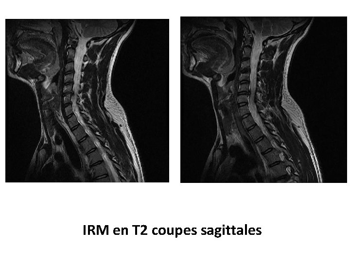 IRM en T 2 coupes sagittales 