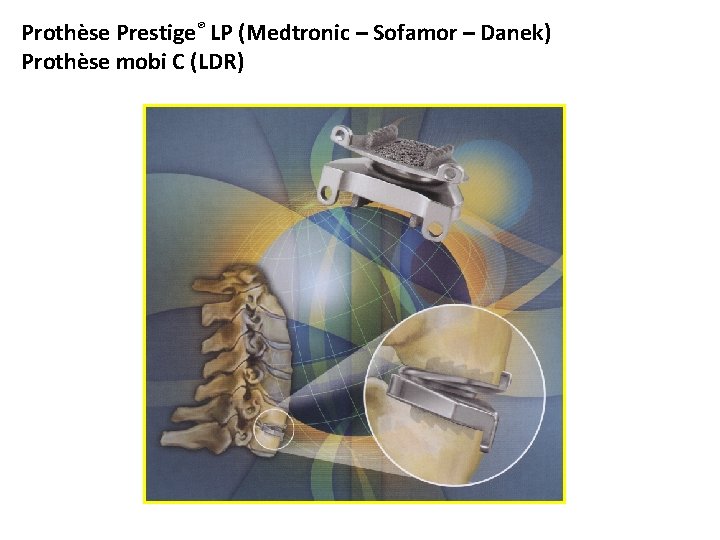 Prothèse Prestige® LP (Medtronic – Sofamor – Danek) Prothèse mobi C (LDR) 