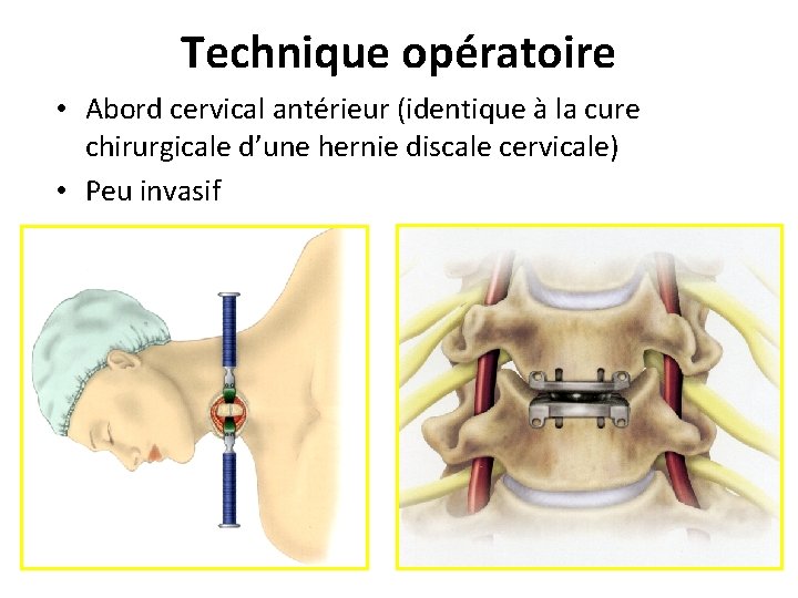 Technique opératoire • Abord cervical antérieur (identique à la cure chirurgicale d’une hernie discale