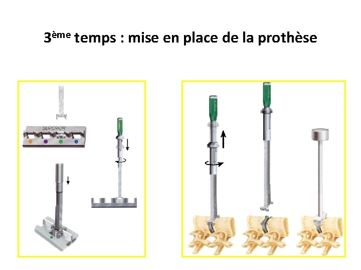 3ème temps : mise en place de la prothèse 