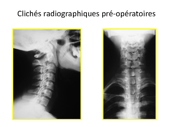 Clichés radiographiques pré-opératoires 