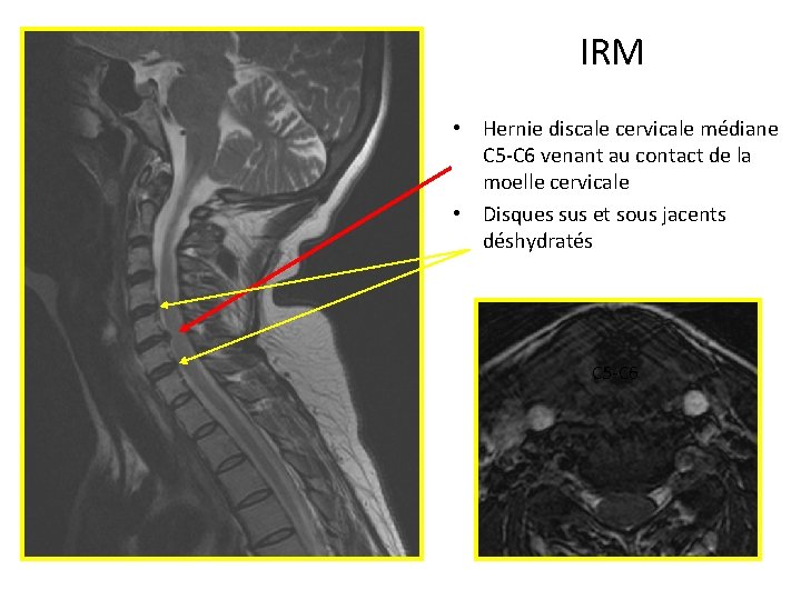 IRM • Hernie discale cervicale médiane C 5 -C 6 venant au contact de