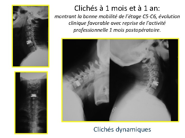 Clichés à 1 mois et à 1 an: montrant la bonne mobilité de l’étage