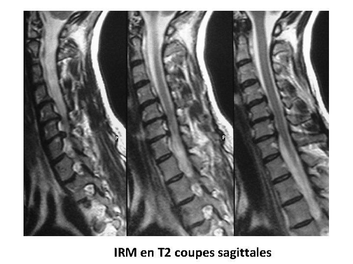 IRM en T 2 coupes sagittales 