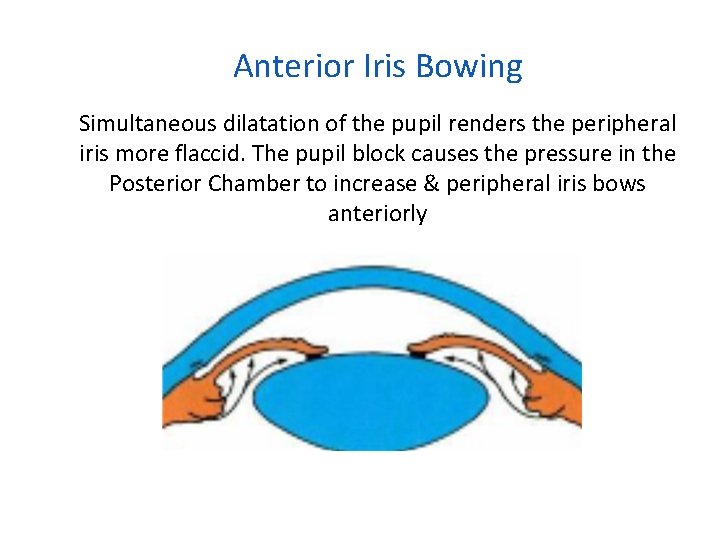 Anterior Iris Bowing Simultaneous dilatation of the pupil renders the peripheral iris more flaccid.