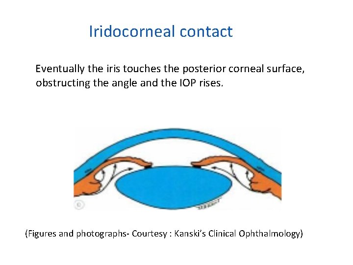 Iridocorneal contact Eventually the iris touches the posterior corneal surface, obstructing the angle and