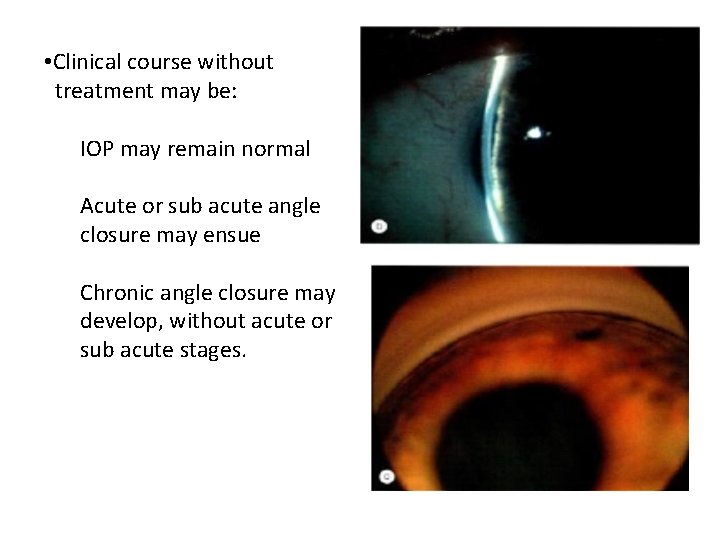  • Clinical course without treatment may be: IOP may remain normal Acute or