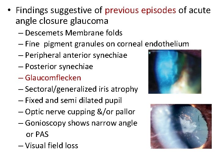  • Findings suggestive of previous episodes of acute angle closure glaucoma – Descemets