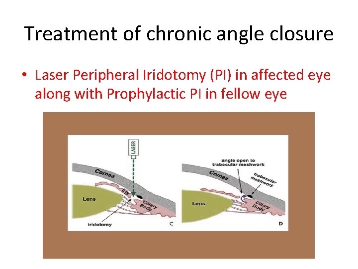 Treatment of chronic angle closure • Laser Peripheral Iridotomy (PI) in affected eye along