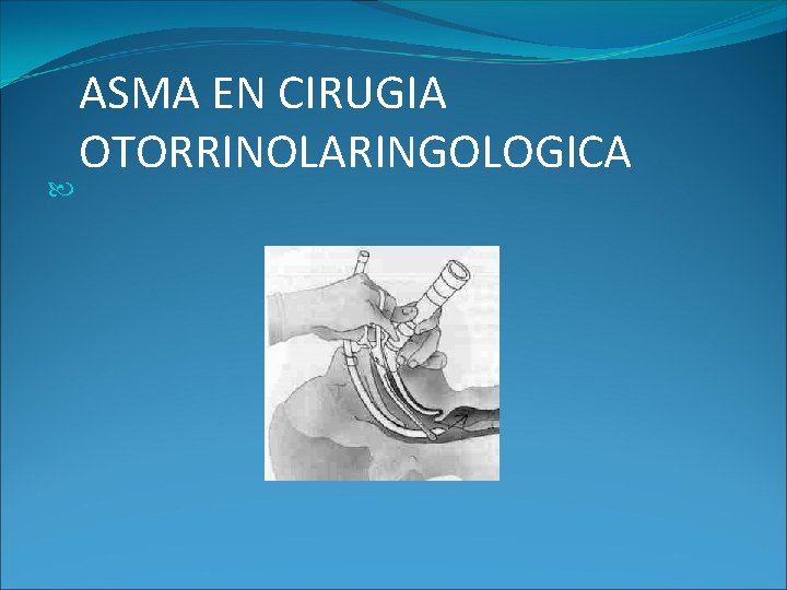ASMA EN CIRUGIA OTORRINOLARINGOLOGICA ASMA EN CIRUGIA OTORRINOLARINGOLOGICA