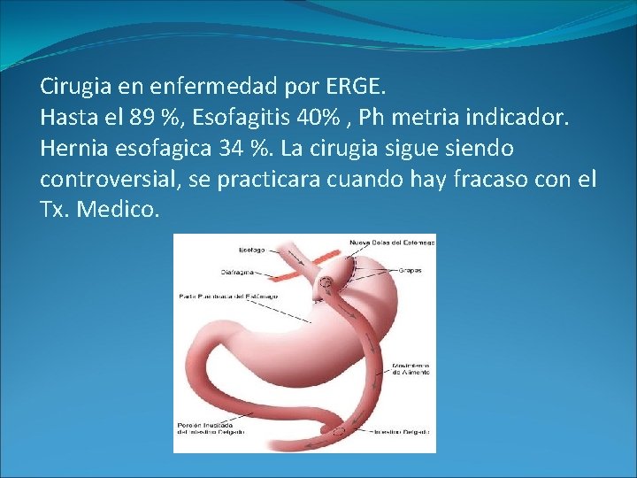 Cirugia en enfermedad por ERGE. Hasta el 89 %, Esofagitis 40% , Ph metria Cirugia en enfermedad por ERGE. Hasta el 89 %, Esofagitis 40% , Ph metria