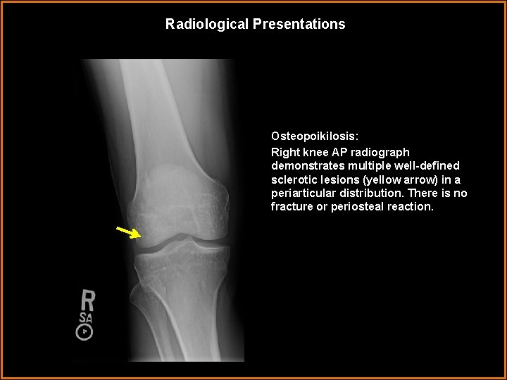 Radiological Presentations Osteopoikilosis: Right knee AP radiograph demonstrates multiple well-defined sclerotic lesions (yellow arrow)