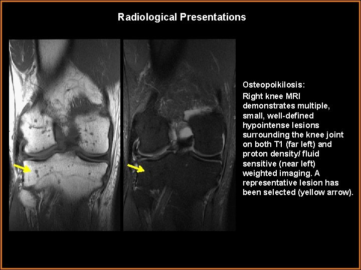 Radiological Presentations Osteopoikilosis: Right knee MRI demonstrates multiple, small, well-defined hypointense lesions surrounding the