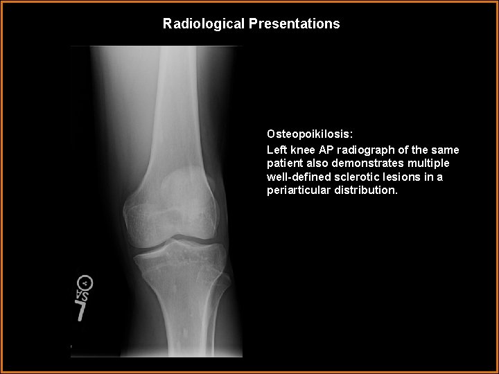 Radiological Presentations Osteopoikilosis: Left knee AP radiograph of the same patient also demonstrates multiple