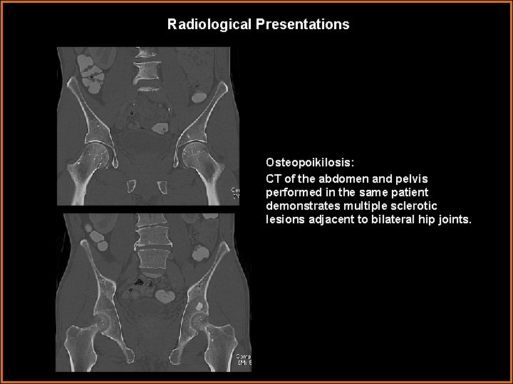 Radiological Presentations Osteopoikilosis: CT of the abdomen and pelvis performed in the same patient