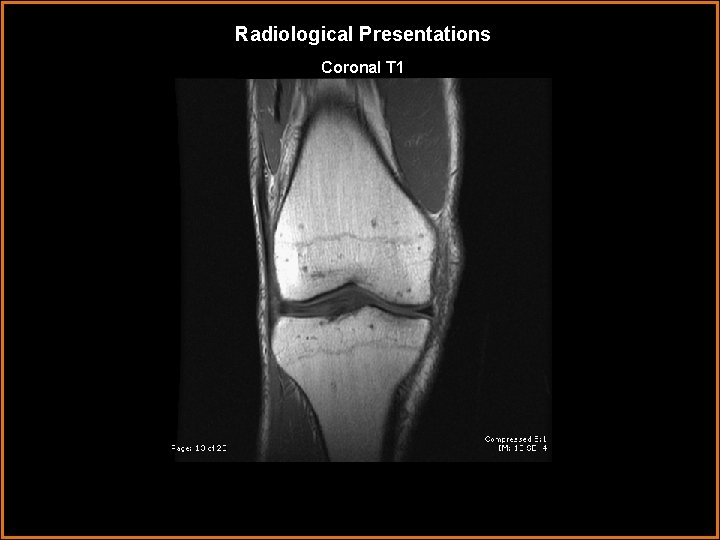 Radiological Presentations Coronal T 1 