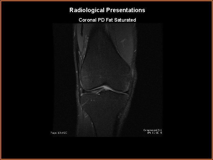 Radiological Presentations Coronal PD Fat Saturated 