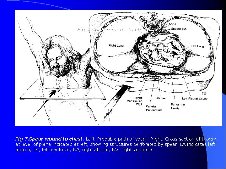 Fig 7. Spear wound to chest. Left, Probable path of spear. Right, Cross section