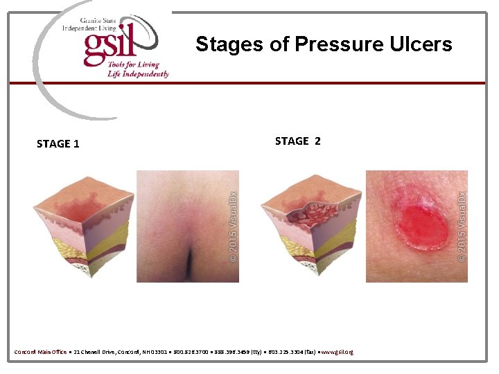 Stages of Pressure Ulcers STAGE 1 STAGE 2 Concord Main Office ● 21 Chenell