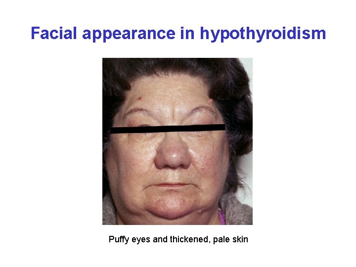 Facial appearance in hypothyroidism Puffy eyes and thickened, pale skin 