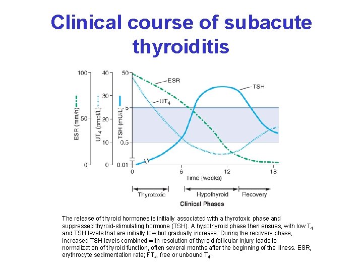 Clinical course of subacute thyroiditis The release of thyroid hormones is initially associated with