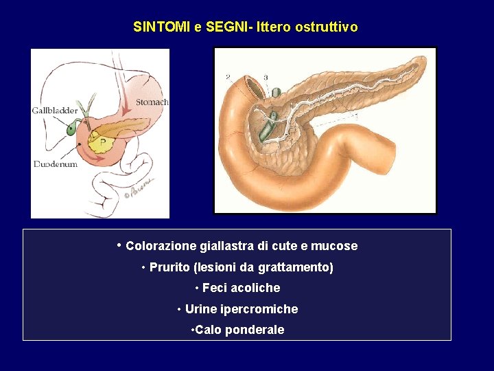 SINTOMI e SEGNI- Ittero ostruttivo • Colorazione giallastra di cute e mucose • Prurito