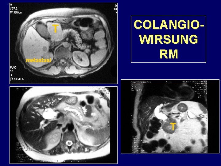 T metastasi COLANGIOWIRSUNG RM T 