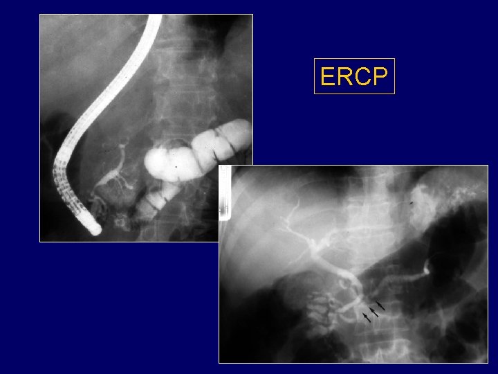 ERCP 