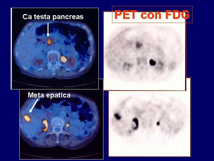 Ca testa pancreas Meta epatica PET con FDG 