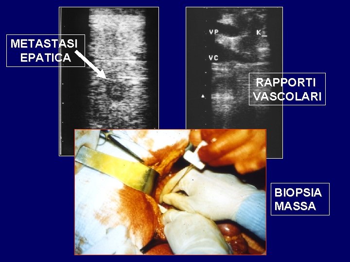 METASTASI EPATICA RAPPORTI VASCOLARI BIOPSIA MASSA 