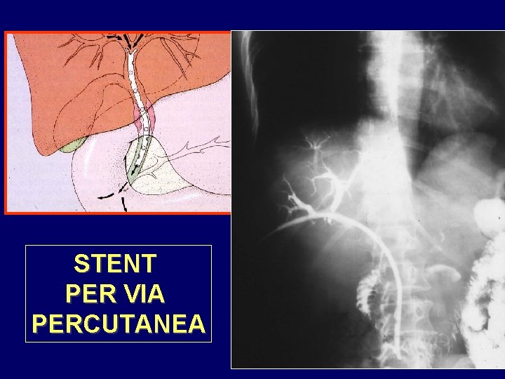 STENT PER VIA PERCUTANEA 