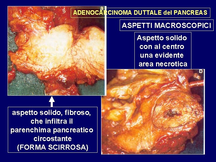 ADENOCARCINOMA DUTTALE del PANCREAS ASPETTI MACROSCOPICI Aspetto solido con al centro una evidente area