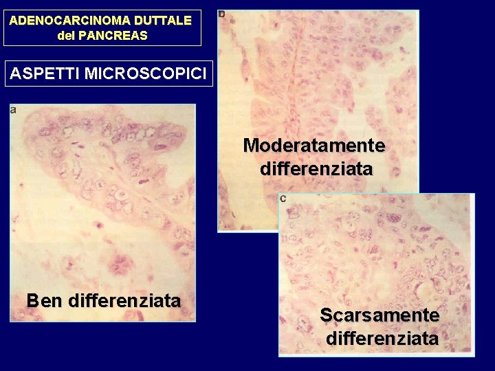 ADENOCARCINOMA DUTTALE del PANCREAS ASPETTI MICROSCOPICI Moderatamente differenziata Ben differenziata Scarsamente differenziata 