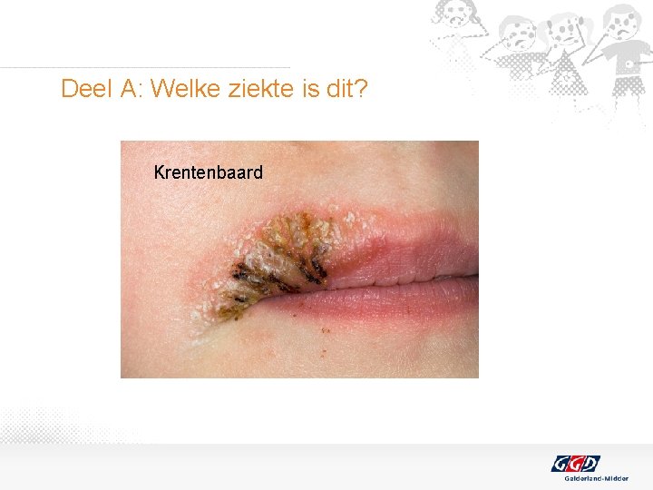 Deel A: Welke ziekte is dit? Krentenbaard 