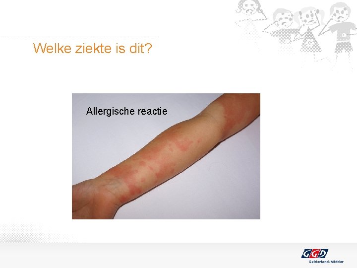 Welke ziekte is dit? Allergische reactie 