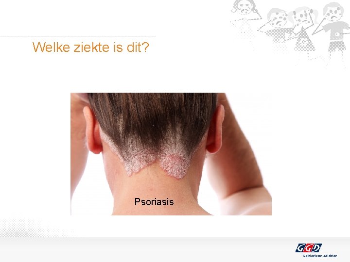 Welke ziekte is dit? Psoriasis 