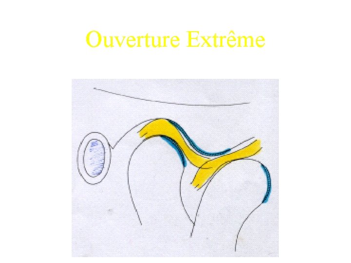 Ouverture Extrême 