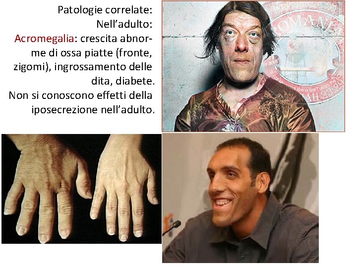 Patologie correlate: Nell’adulto: Acromegalia: crescita abnorme di ossa piatte (fronte, zigomi), ingrossamento delle dita,