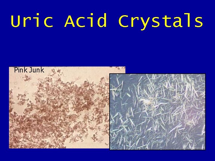 Uric Acid Crystals Pink Junk Uric Acid Crystals Pink Junk