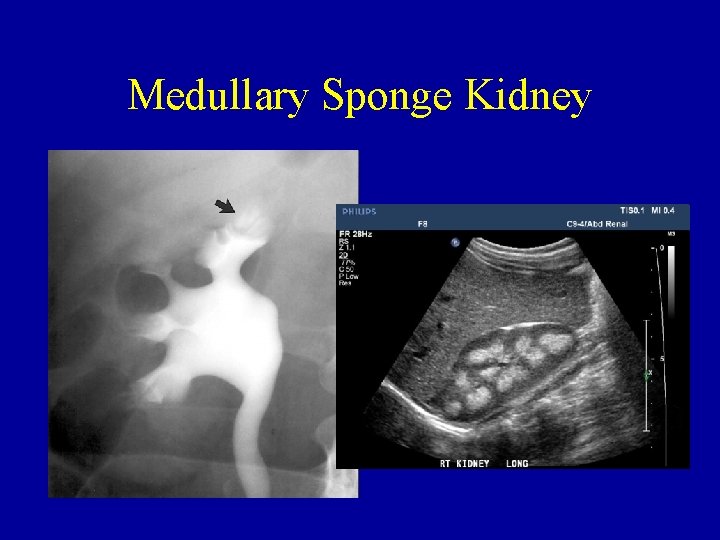 Medullary Sponge Kidney Medullary Sponge Kidney