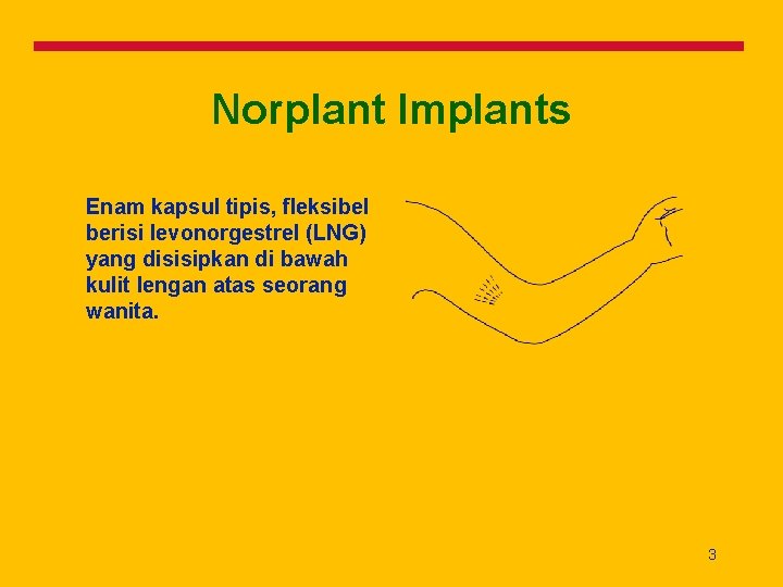 Norplant Implants Enam kapsul tipis, fleksibel berisi levonorgestrel (LNG) yang disisipkan di bawah kulit