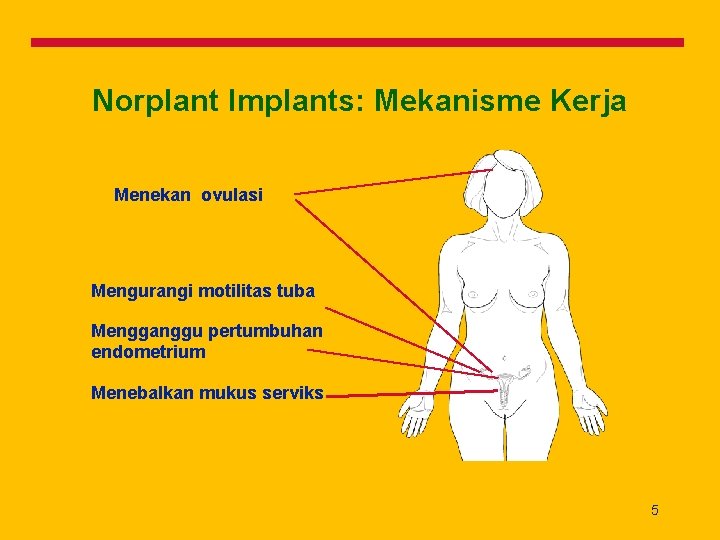 Norplant Implants: Mekanisme Kerja Menekan ovulasi Mengurangi motilitas tuba Mengganggu pertumbuhan endometrium Menebalkan mukus